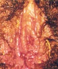 Transmission of Herpes