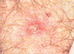 Herpes and HIV