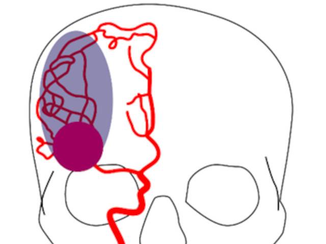 Clinuvel to trial innovative drug in stroke