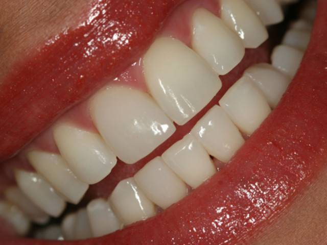 Teeth Whitening Home Remedies