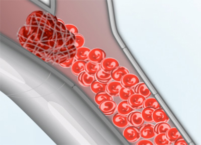 Professor Graeme Hankey and Steve Quinn Atrial Fibrillation Interview