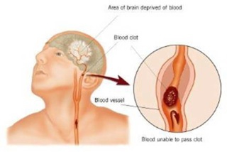 Blood Clots and Stroke Fourth Indicator
