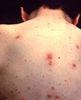 Chickenpox Vaccination