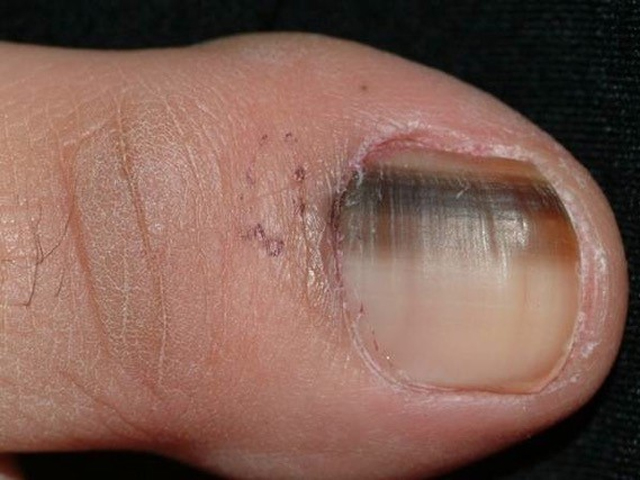 Have You Noticed A Dark Line On One Of Your Nails?