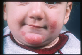 How to manage and prevent your child's eczema flares