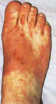 Eczema Research