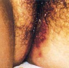 Transmission of Herpes