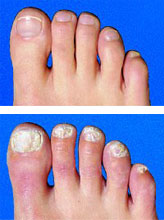Stop fungal nail infection in its tracks this summer