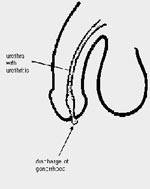 Gonorrhoea (Neisseria gonorrhoea)