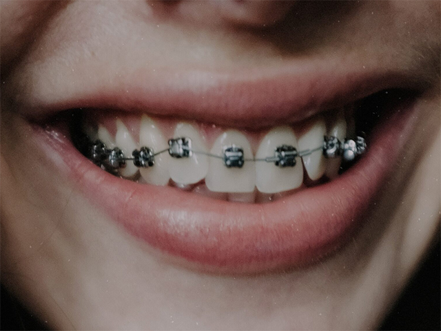 Ceramic Braces vs Metal Braces