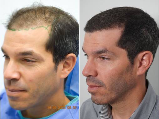Hair Transplant vs. Hair Replacement Systems: Which is Better?