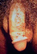 Genital Herpes (herpes simplex 2) - An Overview