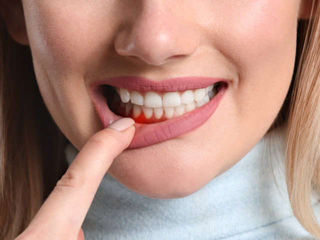 Why Choose Invisalign