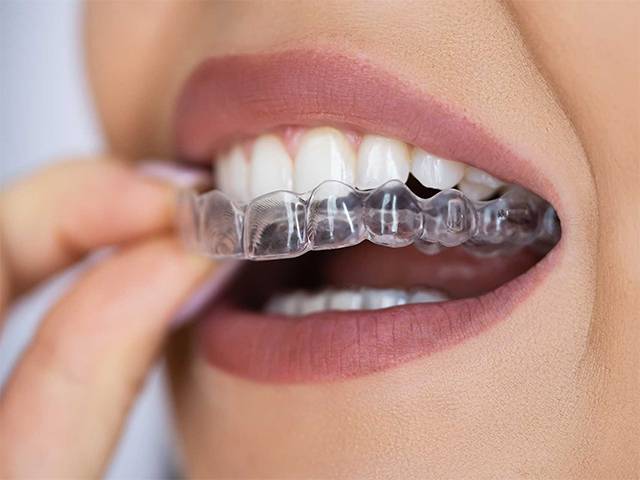 Invisalign vs Spark Aligners