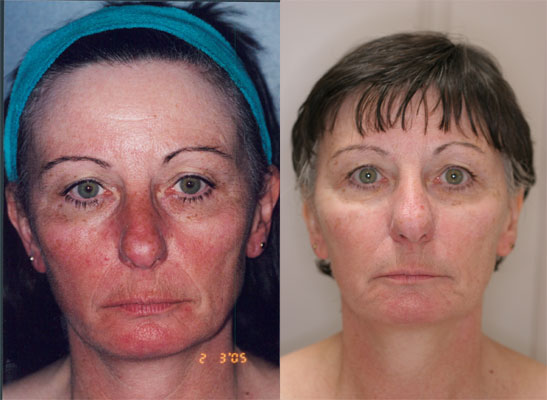 Rosacea Red Skin Condition