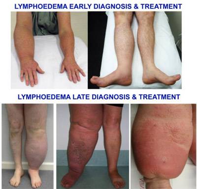 Rotary Clubs Partner with the Australian Lymphology Association