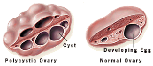 PCOS