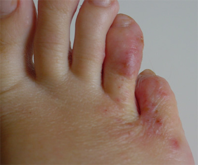 Psoriasis Skin Condition