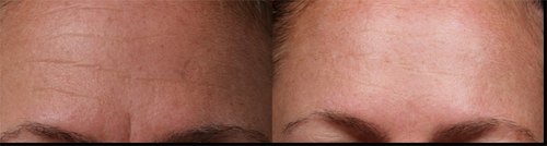 SilcSkin Facial Pad Alternative to Botox