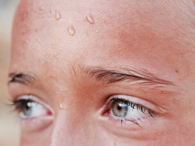 Dermatologist Predicts Mass Sweating Problems As Temperatures Rise