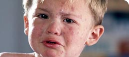 Baby Skin disorders, advice for eczema, nappy rash and sensitivity