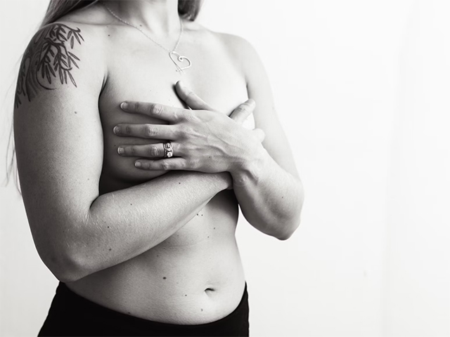 Breast Augmentation